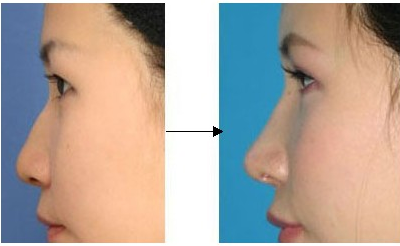 同是隆鼻 男女隆鼻手术有区别
