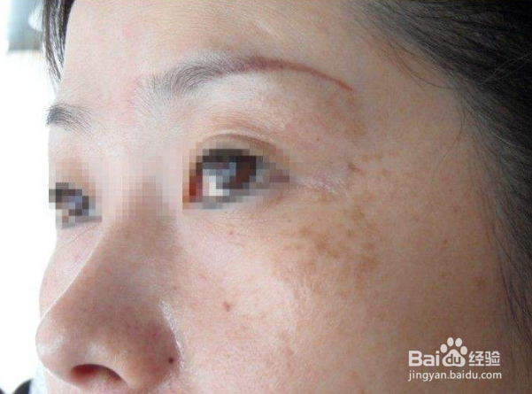 怎么分辨脸上长的什么斑