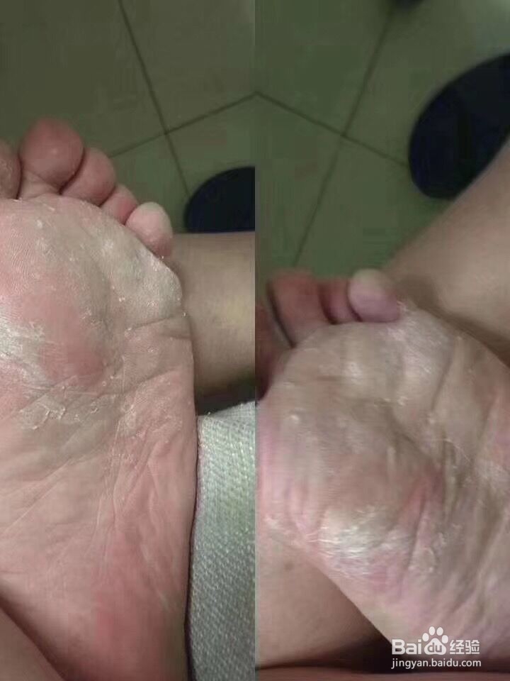 怎样识别不同类型的脚气