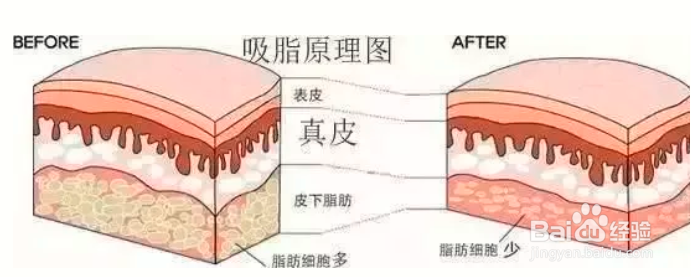 朋友产后一直在想要怎么瘦身,最后选择了吸脂