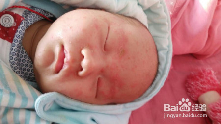 宝宝出现湿疹治疗时,应注意哪些?