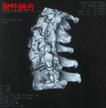 强直性脊椎炎的症状与治疗办法