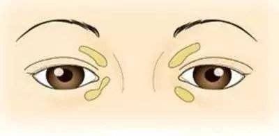 长了睑黄瘤，要注意什么呢?