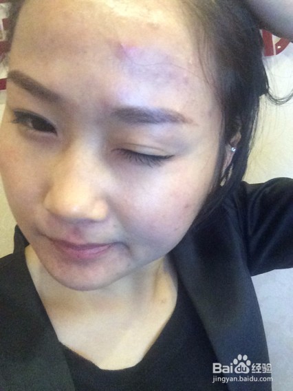 什么去痘印管用?分清类型有效祛痘印