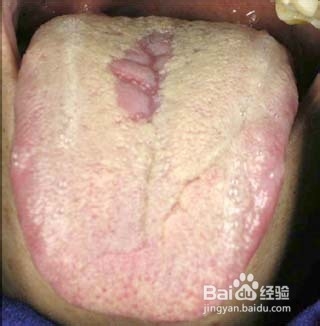 观舌苔辨病症
