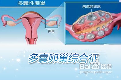 雄性激素分泌旺盛怎么办