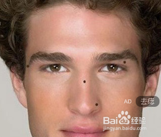 如何美美的安全去痣