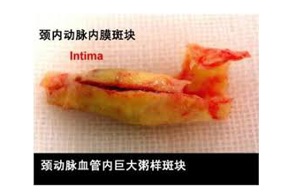 心绞痛怎样治疗	心绞痛是什么原因引起的？