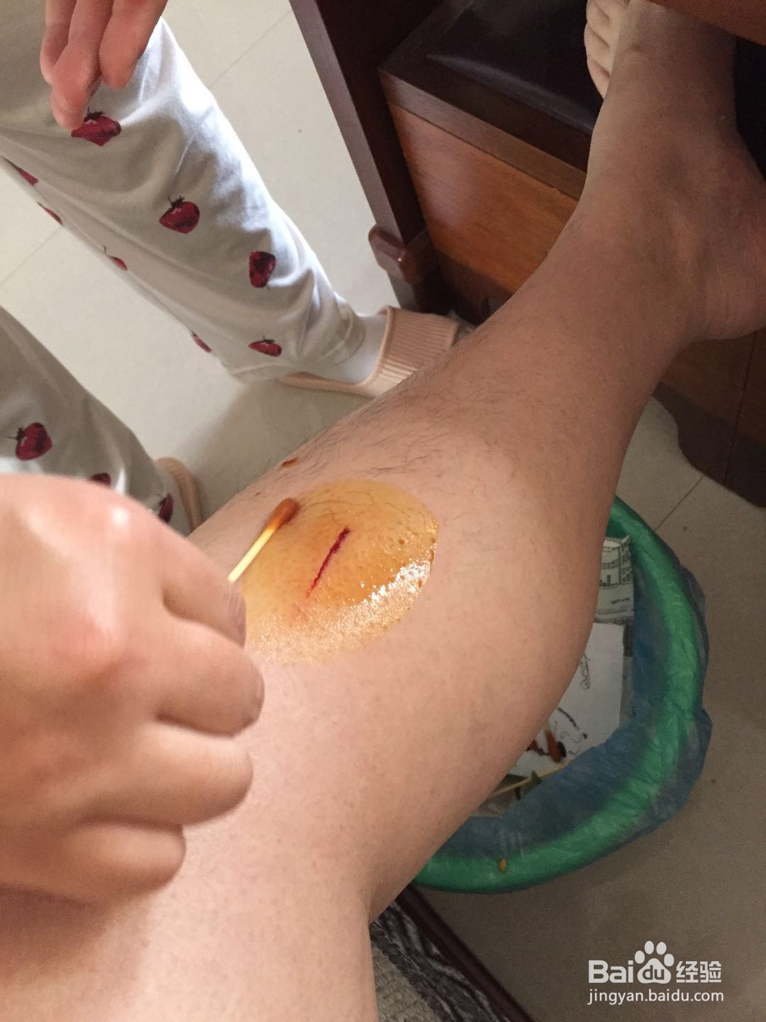 身体出现物品划伤如何处理