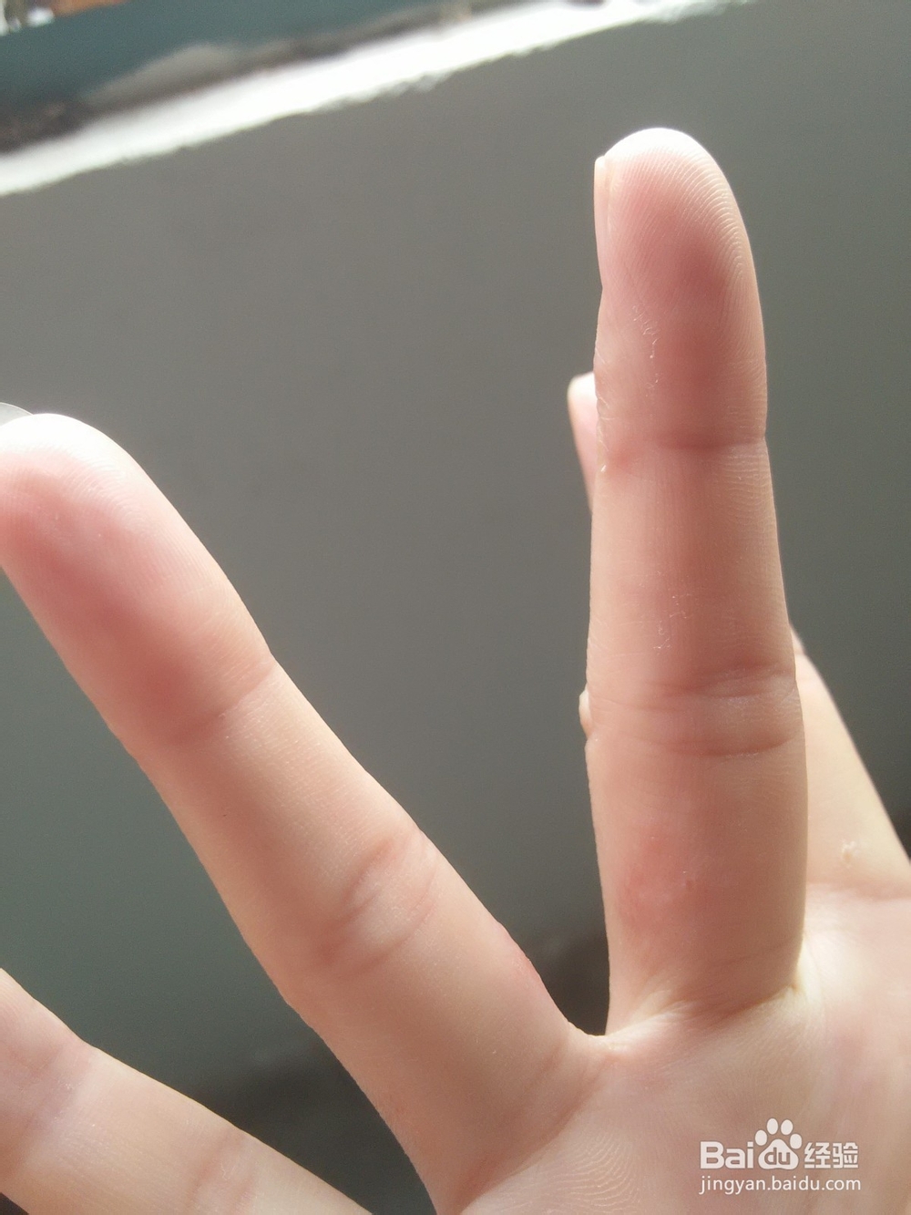 分享手上长水泡如何治愈的方法