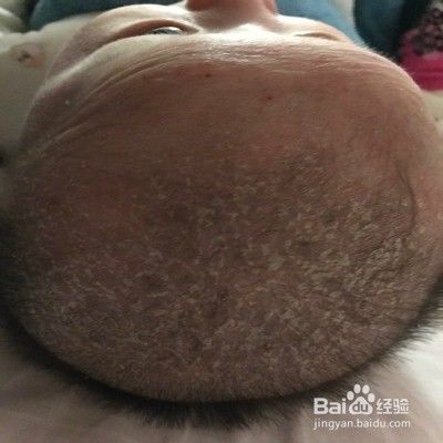 清理宝宝头顶上的乳痂的注意事项
