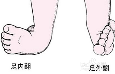 什么是足内翻？
