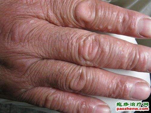 健康/养生 医疗健康 > 皮肤科  汗疱疹的初期症状以深在性的小水泡为