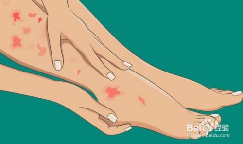 小腿肿胀啥原因,腿部六个征兆应该看医生