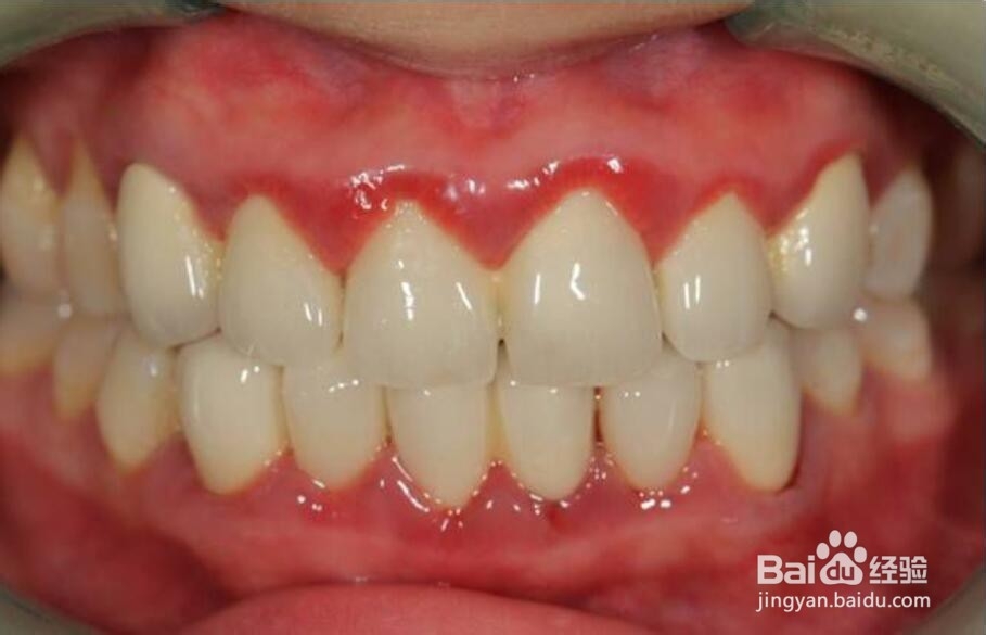 牙周炎牙龈炎的预防治疗方法和注意事项