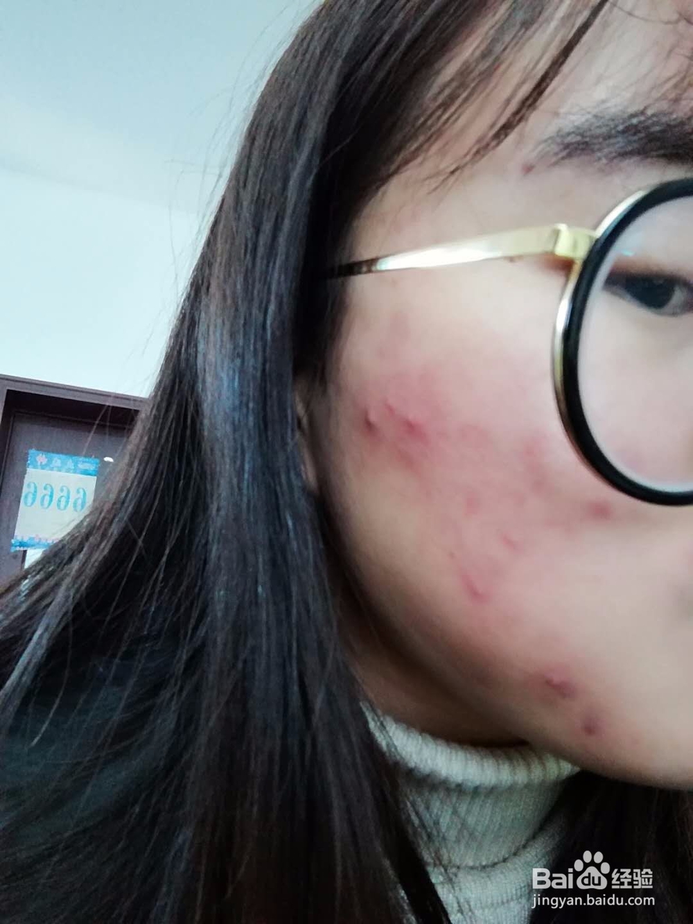 祛痘经验分享