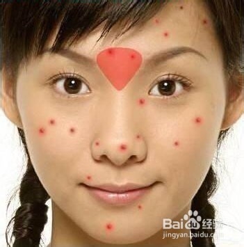了解自己脸上的某个部位长痘痘的原因
