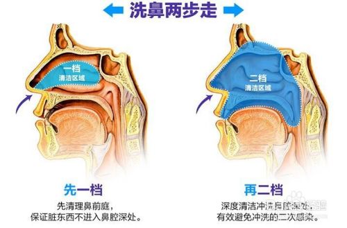 盐水洗鼻治鼻炎的必备常识 百度经验