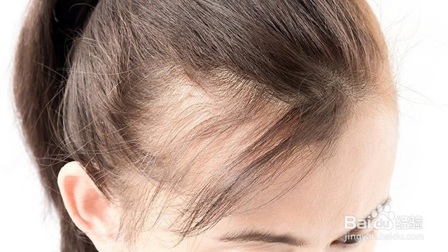 fortro:掉发对生活的影响有那些?