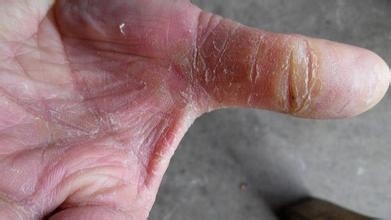 手上起皮是怎么回事