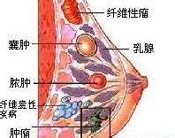 自我按摩防治乳腺增生