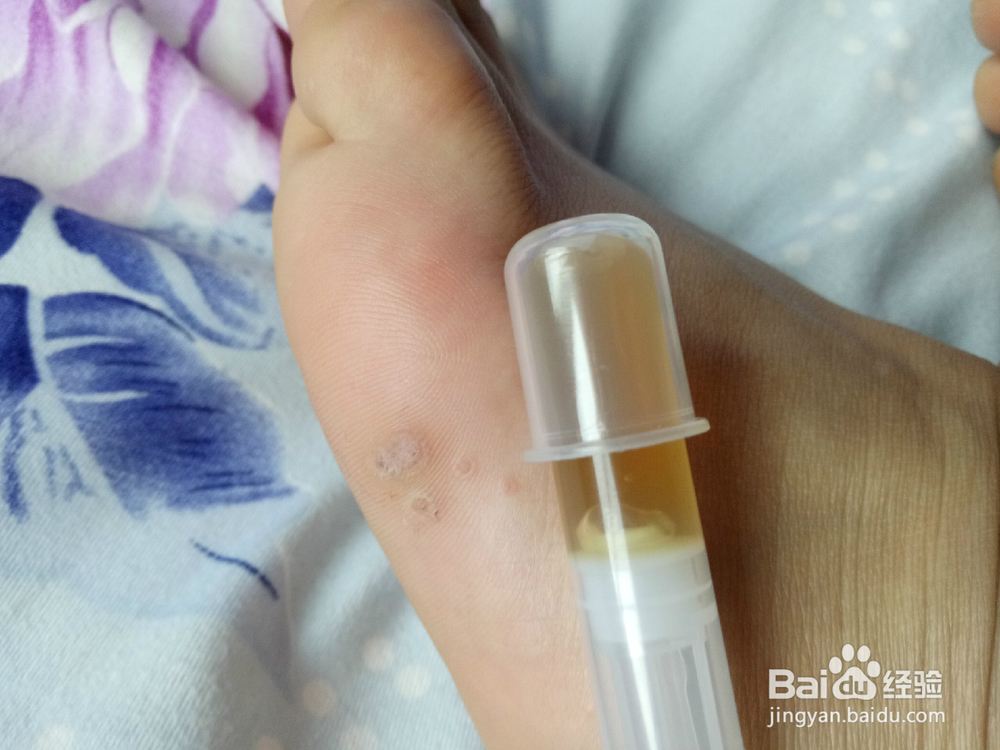 鸡眼治疗小方法