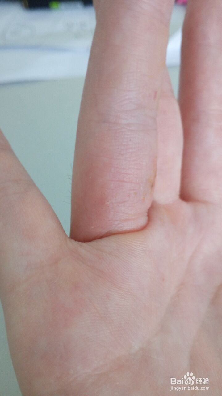 手指小水泡的治疗过程（真实经验）