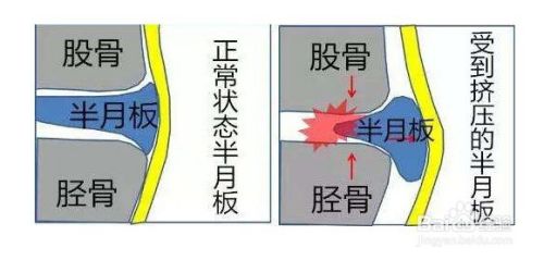 膝盖半月板损伤症状的三个阶段 百度经验