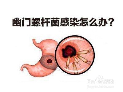 反流性胃炎症状及病因