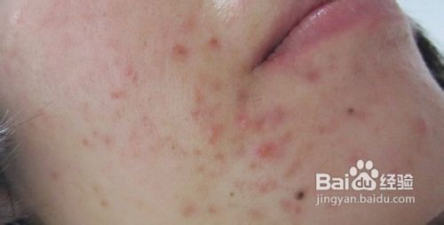 女性长青春痘该肿么办呢?