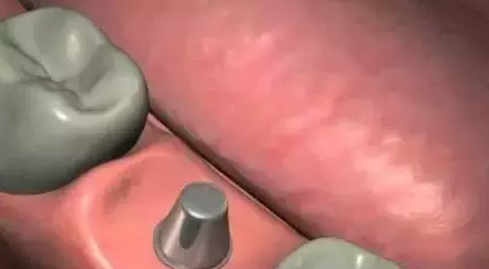 种植牙的过程是怎样的