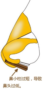 鼻小柱整形解决方案