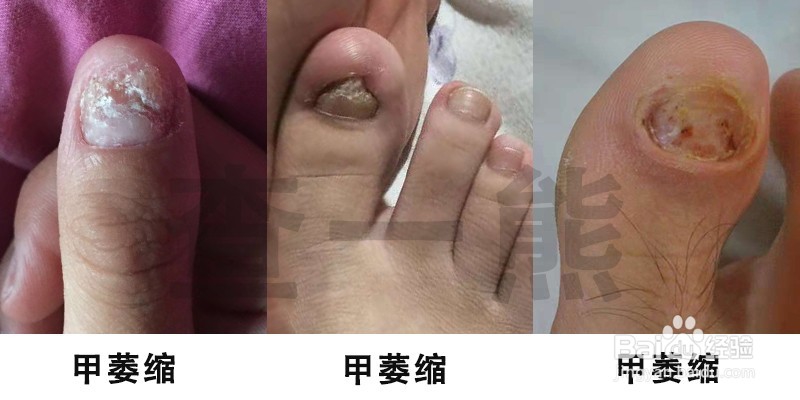 孙叔公灰指甲治疗手册