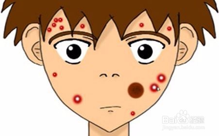 青春痘与成人痘要怎么区别 应该怎么护理