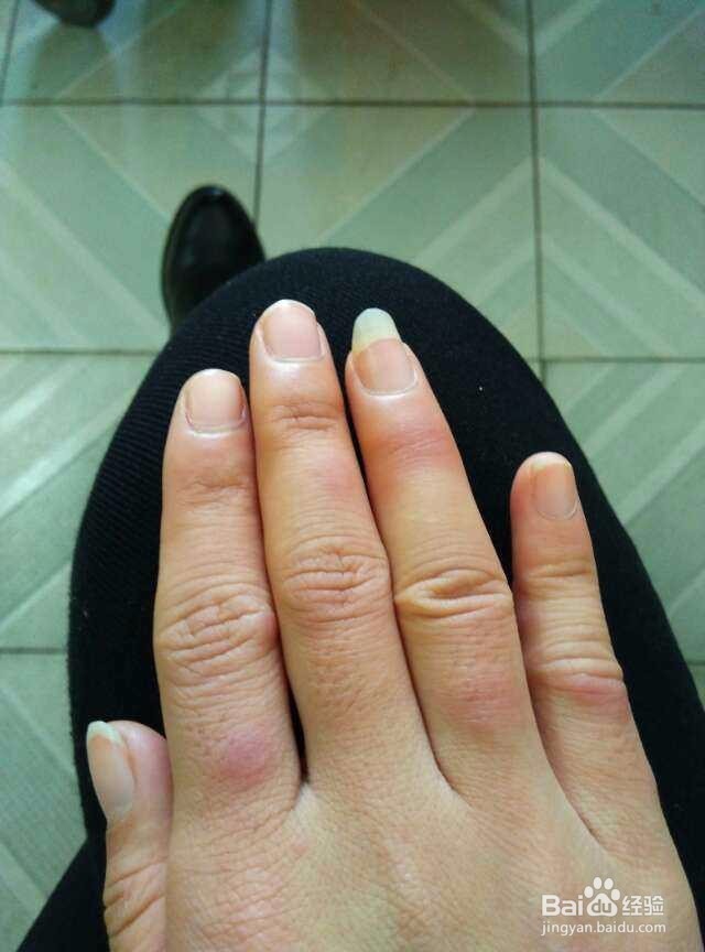 开始长冻疮了,怎么办?