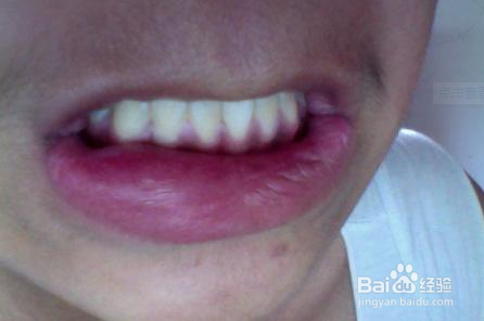 嘴被蚊子咬肿了怎么办