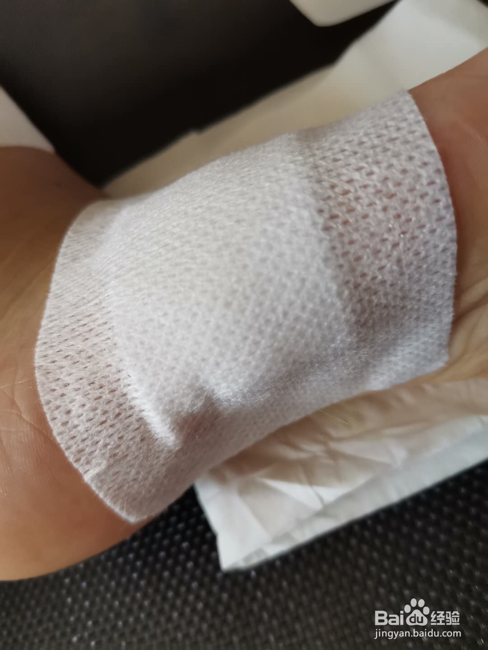 如何挑破脚上的大水泡