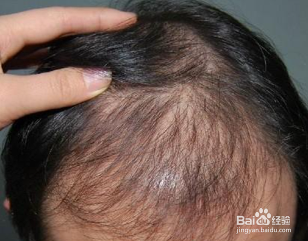 男士头发掉得很严重,应该怎么办
