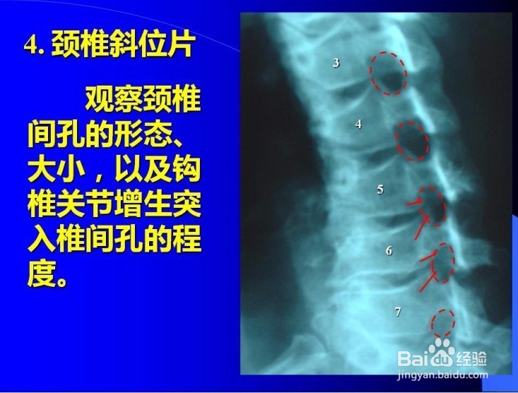 脊椎病的诊断与观片方法