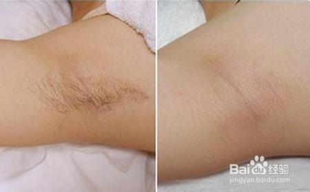 怎样处理腋下脱毛后的毛孔粗大