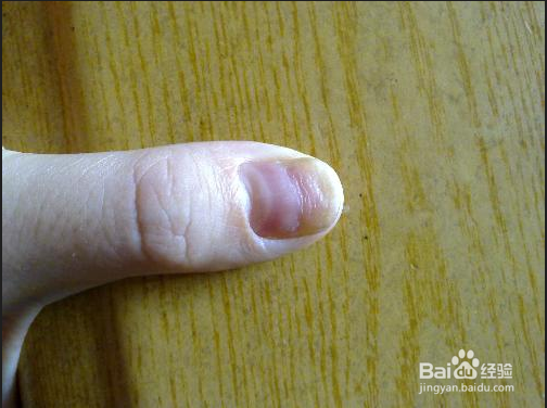 <b>指甲上有横纹是怎么回事</b>