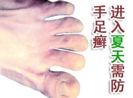如何自我诊断手足癣