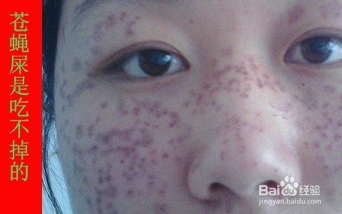 脸上蝇子屎吃什么去除/药水可以点掉苍蝇屎吗