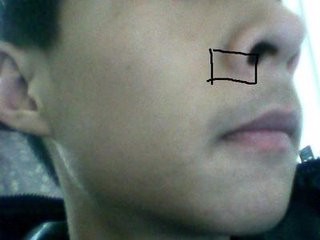 鼻子下面起泡速好方法