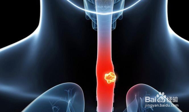 注意饮食习惯,预防食道癌