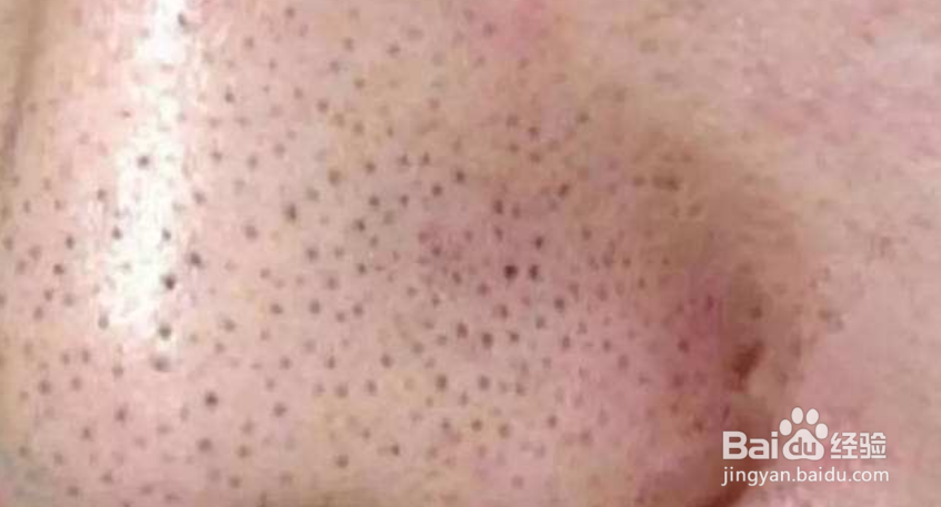 黑头多是什么原因,怎么彻底去除黑头