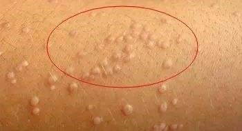 小孩长扁平忧怎么办