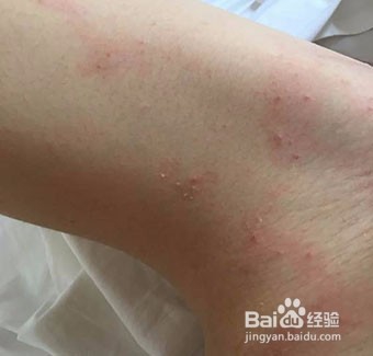 背上有湿疹怎么办