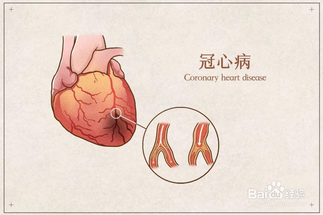 冠心病人易多吃的东西你知道有哪些吗