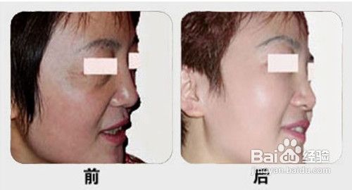 大家可以了解下美白针多少钱